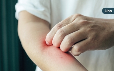 夏日見「隱翅蟲」拍了恐皮膚潰爛！藥師揭「5種藥」修復皮膚不留疤