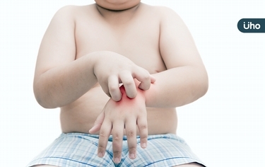 別再抓呀抓呀抓!小孩異位性皮膚炎怎辦?兒科醫教「這樣做」才是正解