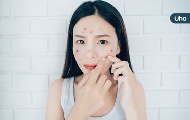 亂擠臉上痘痘不只會留疤!醫警:痘痘長在「這區域」擠壓恐腦膜炎