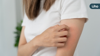 新冠確診後癢不停? 女中醫推薦一茶飲舒緩調理有功效