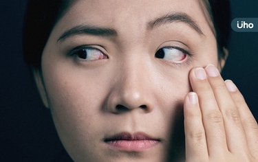 高低眼、眼睫毛倒插⋯小心是「甲狀腺眼疾」醫警告:別誤認老化導致