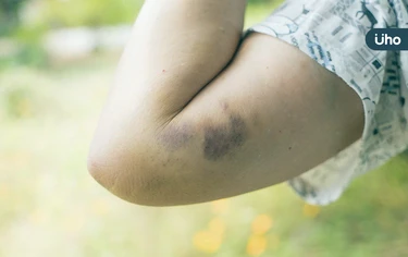手腳常瘀青⋯就是凝血功能出問題?醫揭:恐因缺乏「1營養素」造成