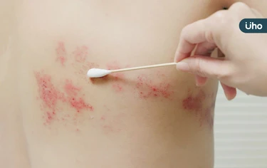 壓力大「皮蛇」纏身!醫揭1表對照「這些族群」患帶狀疱疹飆升風險