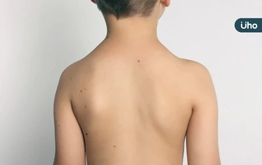 孩子有脊椎側彎嗎?復健醫教「1分鐘自測法」大於●●度建議開刀