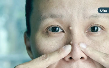 病毒疣易傳染,會自己好嗎?醫揭「4種病毒疣」:這種常誤認老人斑