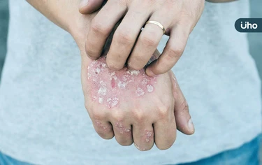 2023乾癬治療新指引》乾癬病灶「清零」不是夢!醫曝「1招」超有效