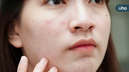 長痘痘做臉才會好?常洗臉才乾淨?錯誤迷思恐讓皮膚變爛,還留永久痘疤!