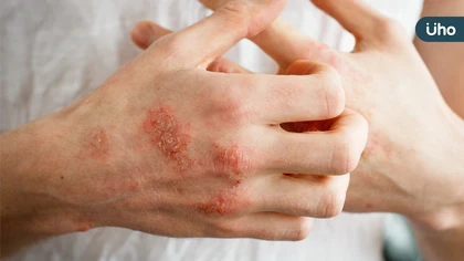異位性皮膚炎治不好?醫:3~4成病患「做這件事」導致越來越嚴重