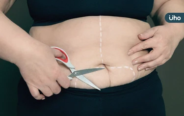 減肥手術能瘦多少?糖尿病可做減肥手術嗎?一文看懂「5QA」防復胖