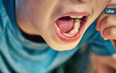 戽斗竟是牙齒「錯咬」造成！醫揭1時機快把握：錯過恐影響顎骨發育