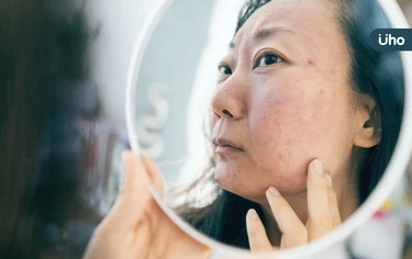 換季發癢又紅腫⋯玫瑰斑復發怎麼辦?皮膚醫教你「這樣做」揪誘發元兇