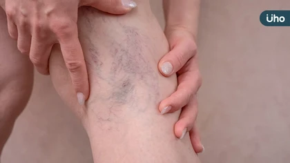 靜脈曲張怎麼消除?中醫促進血液循環妙方