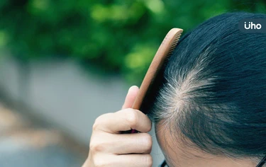 圓形禿會自己好嗎?醫曝「落髮範圍」逾這比例難恢復:小心變宇宙禿
