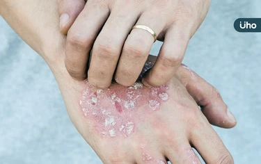 皮膚病也會致命!醫揭乾癬「這類型」全身長滿膿疱⋯恐高燒、器官衰竭