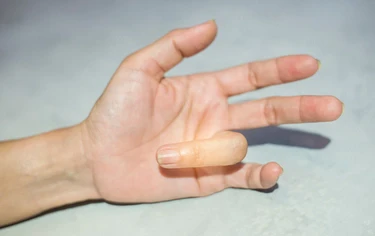 折手指不只關節變粗,恐罹罕見「指部厚皮症」醫曝男性1族群好發