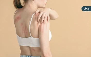 蕁麻疹皮膚癢不是食物過敏?醫揭慢性蕁麻疹「好發2時間」復發有解