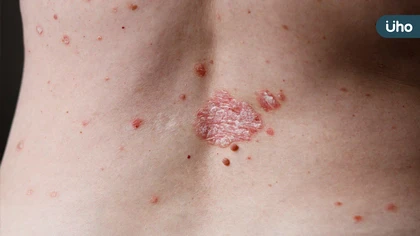 皮蛇(帶狀皰疹)與手摸ATM無關:皮膚科專科醫師糾正錯誤報導並提供正確衛教