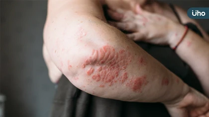 全身佈滿水泡如針刺火燒!「全身型膿疱性乾癬」痛不欲生,老師罹患罕病幾乎無法出門上課