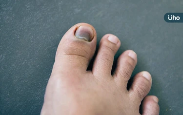 灰指甲不一定是灰色!皮膚科醫揭「這些顏色」更常見:8類人風險高