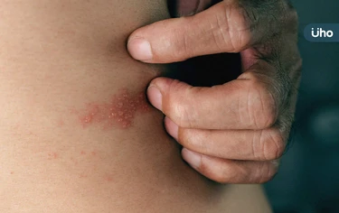 老翁染「皮蛇」竟右手偏癱！醫：糖友患帶狀疱疹神經痛「風險高50%」