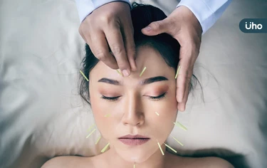 中醫「美顏針」夯什麼？解析原理、功效、適用族群：「這些人」不適用
