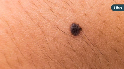 黑色素瘤聞之色變?皮膚早期診斷、跨科合作治療大幅延長存活期