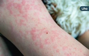 麻疹症狀有哪些?出現1症狀與感冒最不同:外觀如「鹽粒灑在紅肉上」