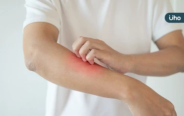 濕疹反覆發作怎麼辦?醫列「抗發炎食物」能改善:補充2種營養素