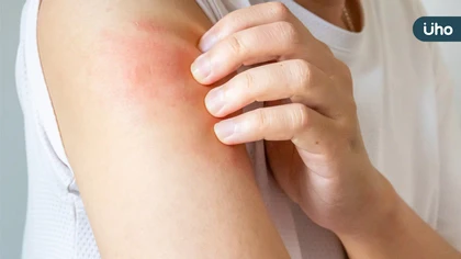 異位性皮膚炎不癢有解方!醫師來解答