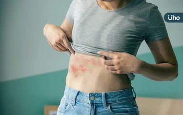 腎友患「皮蛇」風險高1.4倍！醫警「這年齡後」慎防感染：恐傷心血管