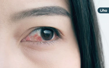 眼妝卸不乾淨，當心變紅腫兔子眼！醫教「正確卸妝法」棉片停留●●秒