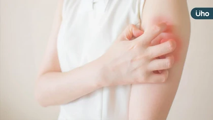 好不了的濕疹?乾癬?小心是罕見的皮膚T細胞淋巴瘤