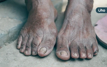 比心肌梗塞、中風死亡率高!醫揭「糖尿病足」恐截肢:護足5招可預防