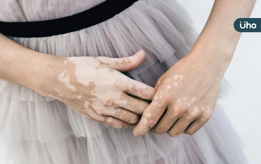 身上冒出白色斑塊？醫揪「白斑症」不控制恐擴散：從臉到腳都遭殃