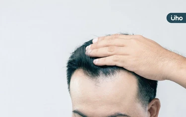 男子茂密髮量越來越禿⋯竟因感染梅毒!皮膚科醫揭「常見掉髮原因」