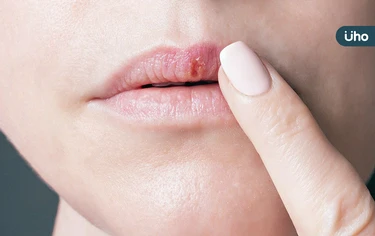 嘴唇冒出小水泡，小心唇皰疹找上你！醫列「5件事」千萬不可以做