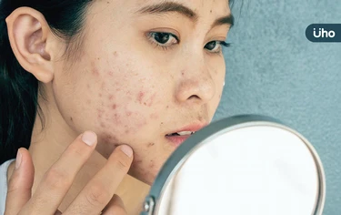 長痘痘是臉不乾淨，平常要多洗臉？中醫揭「1關鍵」千萬別過度清潔