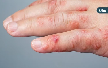 手掌出現小水泡，小心汗皰疹發作！醫教「6招」預防：別直接摸肥皂