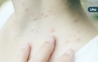 身上長膿包竟不是青春痘？醫揪「芽孢菌毛囊炎」1症狀與痘痘不同