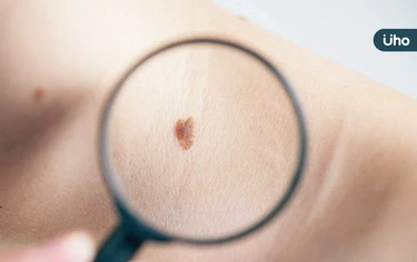 身上長痣是皮膚癌嗎？快速變大、凸起⋯當心「4類黑痣」恐長惡性腫瘤