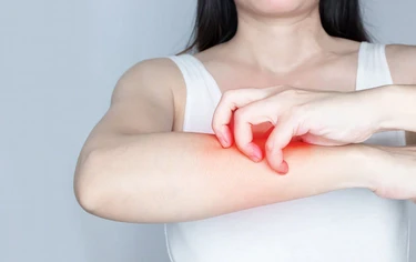 一換季全身癢爆？醫認證蕁麻疹「7大止癢攻略」這些食物先別吃