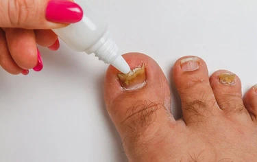 灰指甲跟香港腳有關？皮膚科醫揭好發族群：手部也可能被黴菌感染