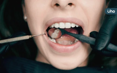 牙齒有黑點，是蛀牙還是「牙齒染色」？醫教1招判斷：看有無凹洞