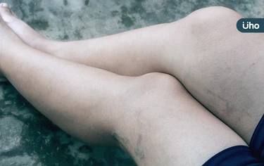 6旬婦工作久站致靜脈曲張！醫揭「3族群」小心腿部腫脹、潰瘍