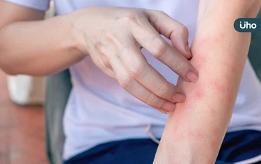 乾燥、皮疹⋯全身癢又痛！台大醫揭「異位性皮膚炎」恐是免疫失調