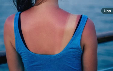 曬傷敷蘆薈、小黃瓜⋯恐害皮膚過敏發炎？醫授「正確皮膚保養」4招