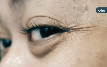 「眼袋VS臥蠶」傻傻分不清？醫教「1招」辨別：微笑時有沒有凸起