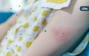 去菲律賓玩小心！「諾氏瘧」20年後再現台灣：早期症狀跟流感很像