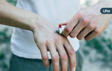 被蚊子叮「抹大蒜泥」可止癢？醫列正確止癢法：只需沖洗冰敷即可