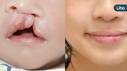 兔寶爸媽成長工作坊歷十屆有成，台灣唇顎裂產前診斷與產後治療的典範轉移